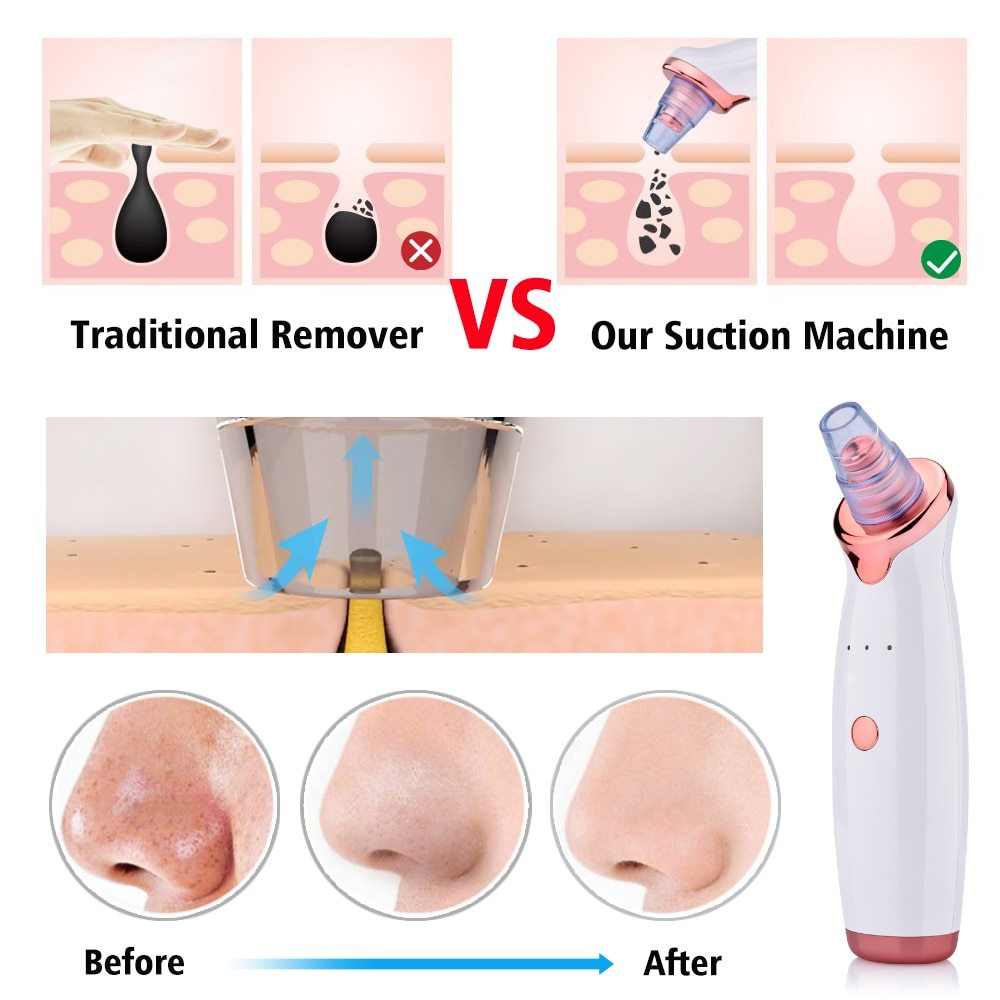 Blackhead Instrument Electric Suction Facial Washing Instrument Beauty Acne Cleaning Blackhead Suction Instrument😍